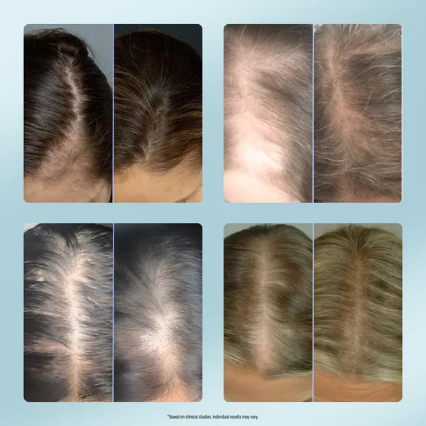 Kavellen® Recupera tu Cuero Cabelludo